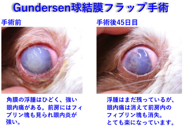 Gundersen球結膜フラップ手術前後の比較画像