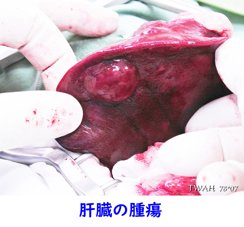 肝臓腫瘍