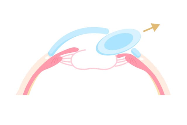 囊外摘出術のイラスト