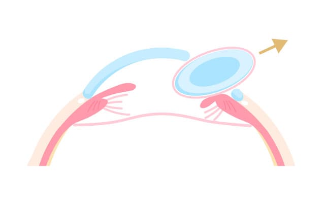 嚢内摘出術のイラスト