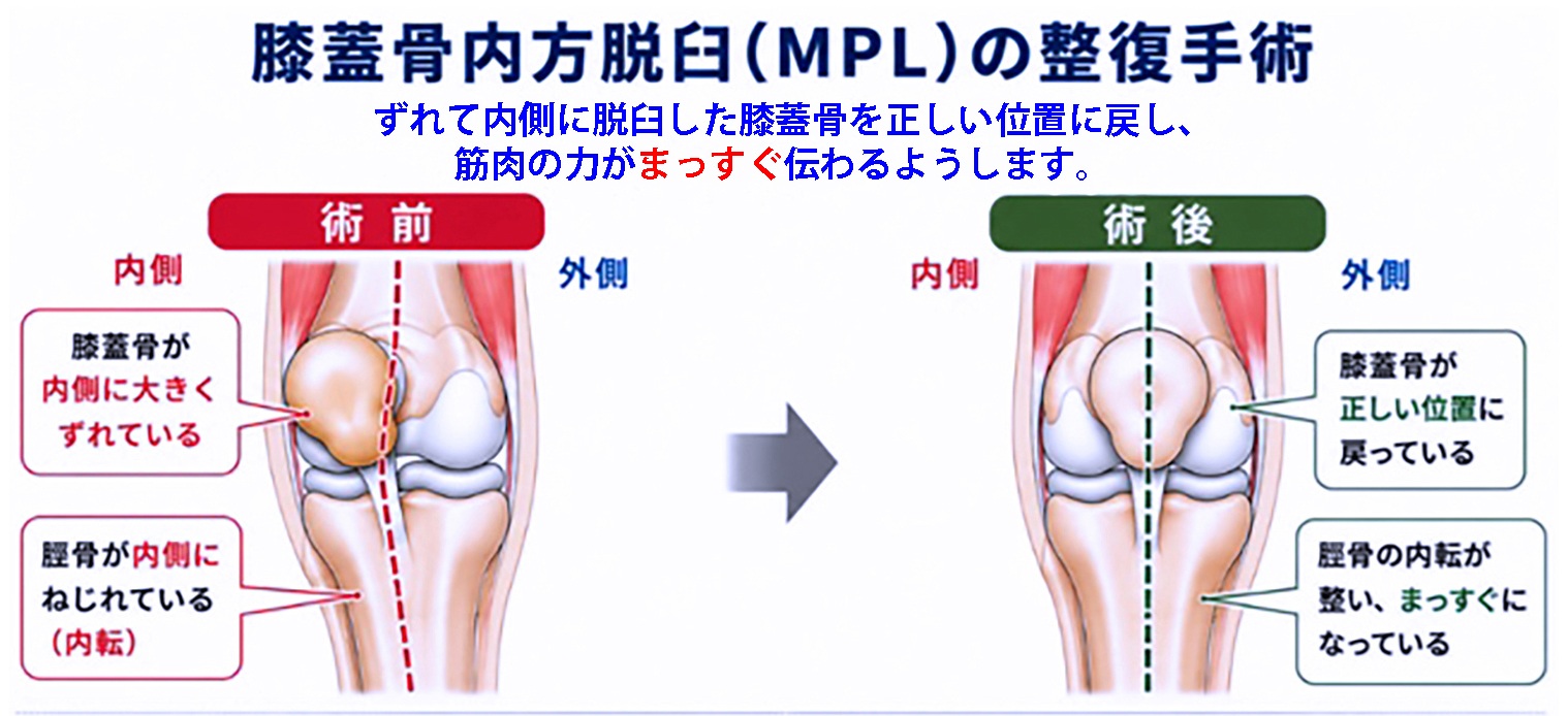 膝蓋骨内方脱臼(MPL)の整復手術。ずれて内側に脱臼した膝蓋骨を正しい位置に戻し、筋肉の力がまっすぐ伝わるようにします。