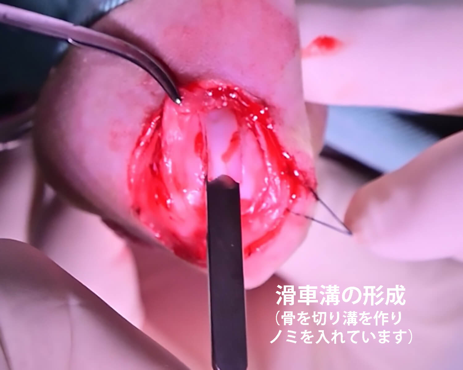滑車溝の形成