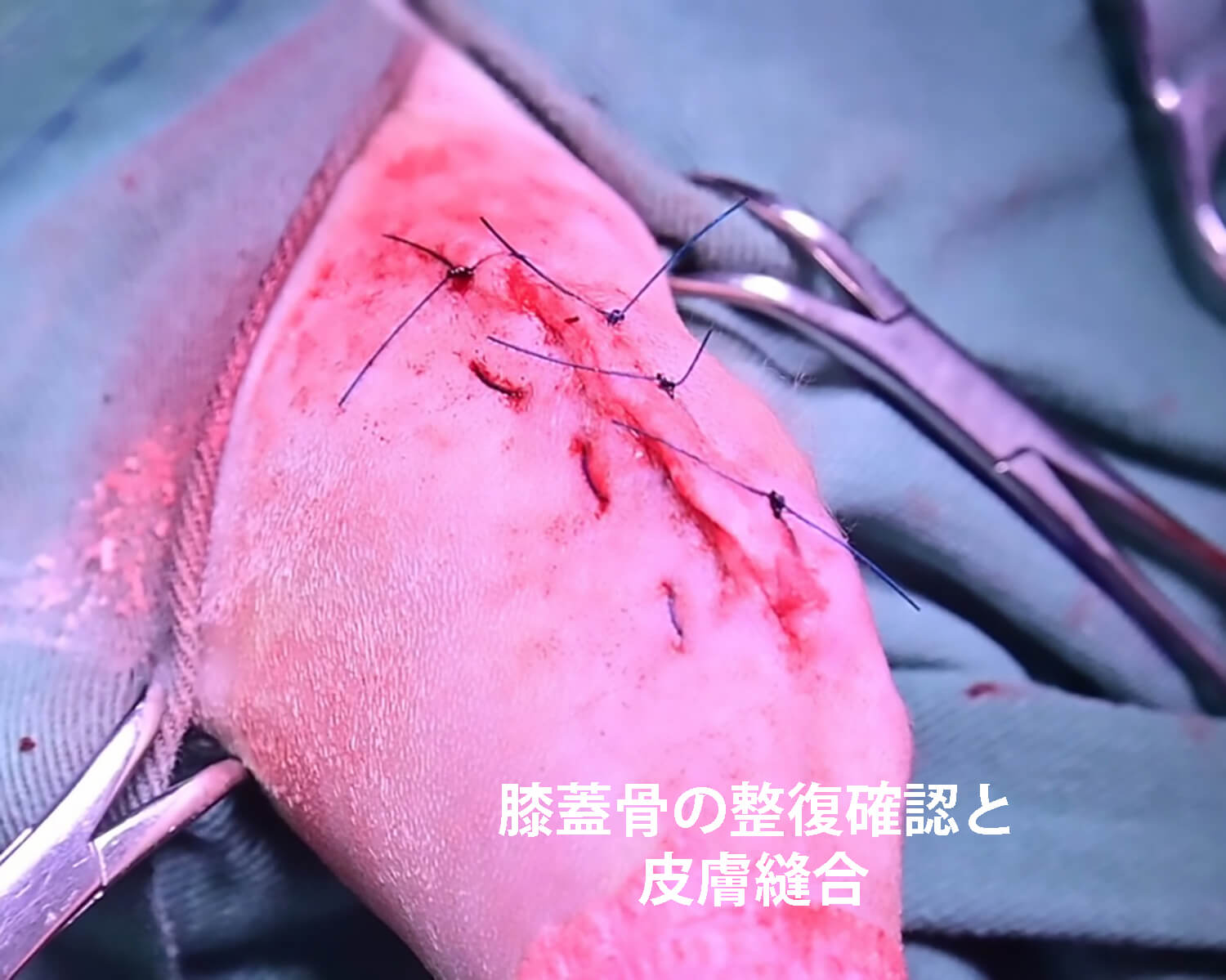整復チェック・皮膚縫合