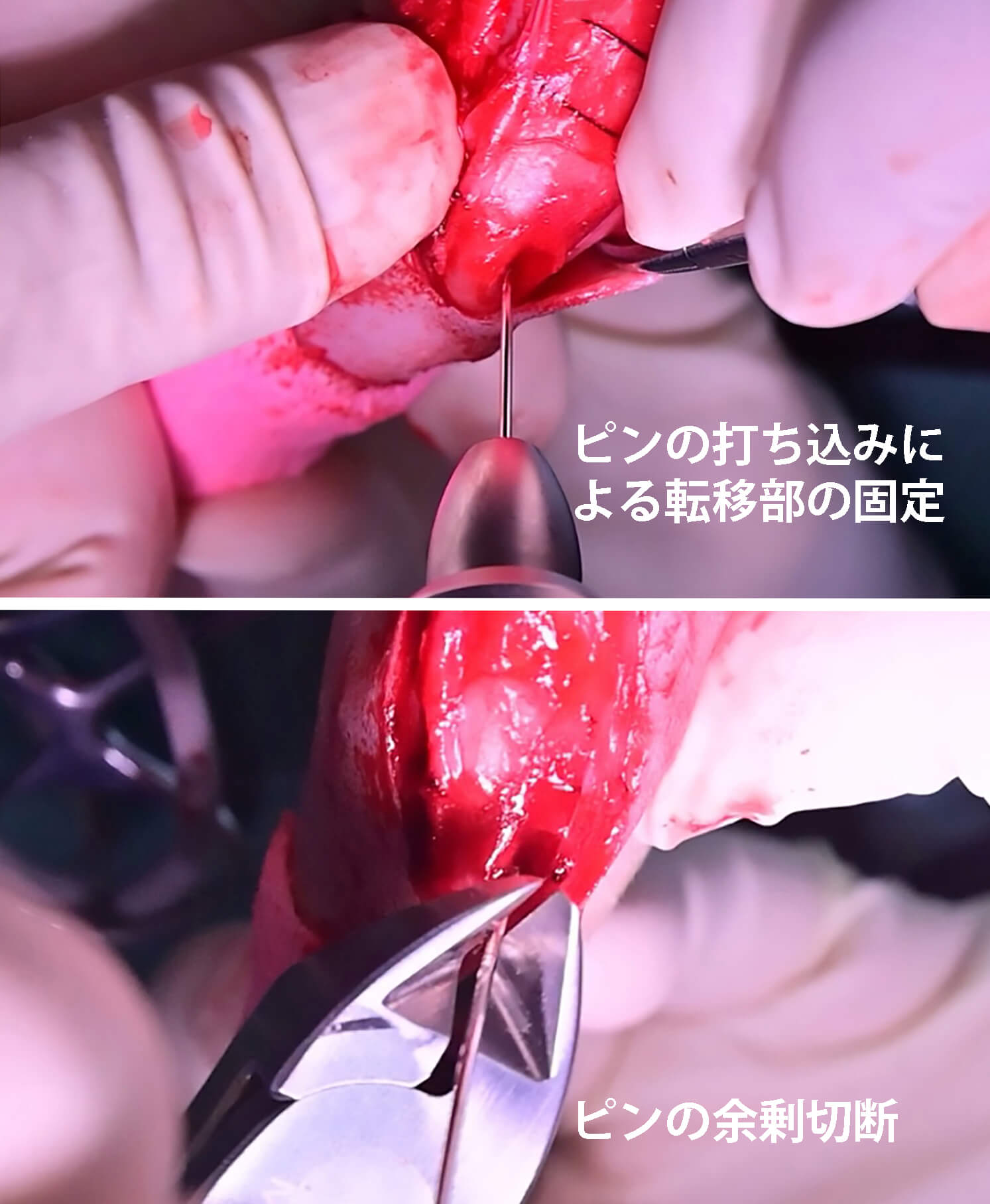 精密なピン固定と余剰切断