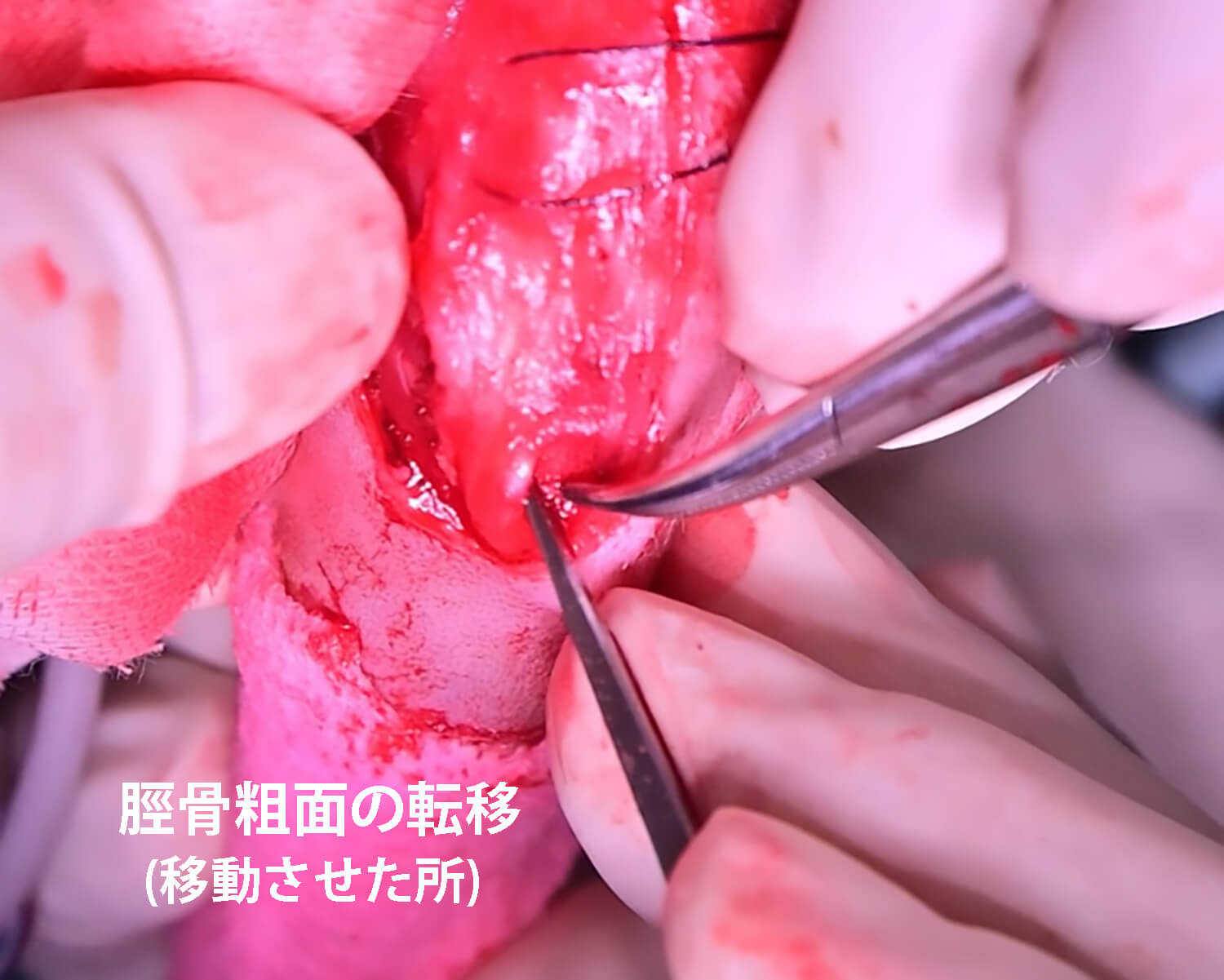 脛骨粗面転位術